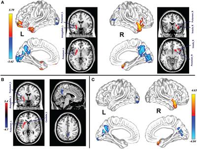 Contribution of cerebrospinal fluid antibody titers and sex to acute cerebral blood flow in patients with anti-NMDAR autoimmune encephalitis